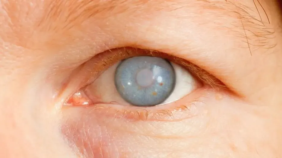 Eye specialist examining a patient for ICL procedure and glaucoma treatment