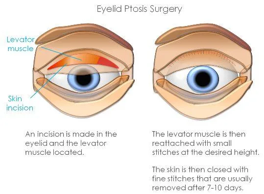 Ptosis surgery performed by top surgeons in Delhi NCR & Mumbai