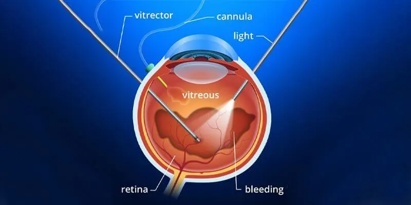 Ophthalmologist performing vitrectomy eye surgery using precision instruments
